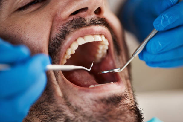 Best Emergency Root Canal Treatment in Litchfield, IL